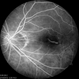 Myopic CNV Myopic CNV