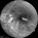 Myopic CNV Myopic CNV