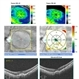 Myopic CNV Myopic CNV