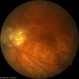 Myopic CNV Myopic CNV