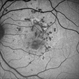 Punctate Inner Choroidopathy Complicated with CNV Punctate Inner Choroidopathy Complicated with CNV