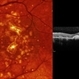 Punctate Inner Choroidopathy Complicated with CNV Punctate Inner Choroidopathy Complicated with CNV