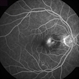 Choroidal Neovascularization, Idiopathic Choroidal Neovascularization, Idiopathic