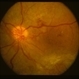 NVD with fibrosis from PDR NVD with fibrosis from PDR