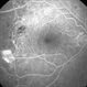 Proliferative diabetic retinopathy Proliferative diabetic retinopathy