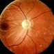Neuroretinitis