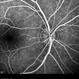 Neuroretinitis