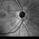 Neuroretinitis Neuroretinitis