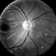Neuroretinitis Neuroretinitis