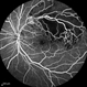 Non-perfused BRVO Non-perfused BRVO