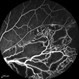Non-perfused BRVO Non-perfused BRVO