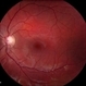 Normal Retina