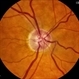 Normtension Glaucoma