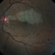 Cilioretinal Artery Occlusion with Central Retinal Vein Occlusion