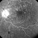 Cilioretinal Artery Occlusion with Central Retinal Vein Occlusion