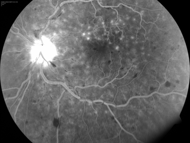 Cilioretinal Artery Occlusion with Central Retinal Vein ...