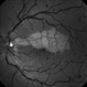 Cilioretinal Artery Occlusion with Central Retinal Vein Occlusion