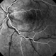 Cilioretinal Artery Occlusion with Central Retinal Vein Occlusion Cilioretinal Artery Occlusion with Central Retinal Vein Occlusion