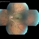 Cilioretinal Artery Occlusion with Central Retinal Vein Occlusion