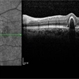 Polypoidal Choroidal Vasculopathy-OCT