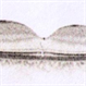 OCT - Laser Induced Retinopathy OCT - Laser Induced Retinopathy
