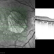 Central Areolar Choroidal Dystrophy Central Areolar Choroidal Dystrophy