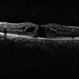 Tamoxifen Retinopathy- OCT Tamoxifen Retinopathy- OCT