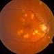 Multifocal Choroiditis