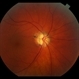 Optic Disc Drusen Optic Disc Drusen