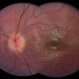 Optic Disc Edema With Macular Star, 6 Weeks After Presentation