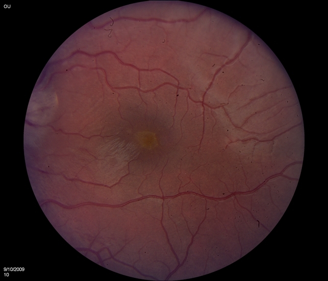 Optic Disc Edema With Macular Star at Presentation - Retina Image Bank