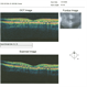 Optic Disc Edema With Macular Star, OCT 6 Weeks After Presentation Optic Disc Edema With Macular Star, OCT 6 Weeks After Presentation