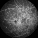 Stargardt Disease Stargardt Disease
