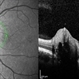 Optic Disc Drusen