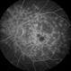 Stargardt Disease Stargardt Disease