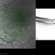 Central Areolar Choroidal Dystrophy Central Areolar Choroidal Dystrophy