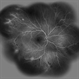 Ocualr Ischemic Syndrome Ocualr Ischemic Syndrome