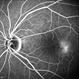 Macular Teleangiectasia Macular Teleangiectasia