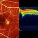 Macular Teleangiectasia Macular Teleangiectasia