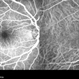 Multiple Evanescent White Dot Syndrome (MEWDS) Multiple Evanescent White Dot Syndrome (MEWDS)