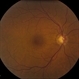 Optic Cupping With Neovascularization