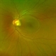 Optic Pit Maculopathy - Fundus Photograph