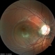 Optic Nerve Pit OD Optic Nerve Pit OD