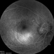 Optic Nerve Pit OD Optic Nerve Pit OD