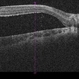 Optic Nerve Pit 2 Optic Nerve Pit 2