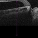 Optic Nerve Pit OCT Optic Nerve Pit OCT