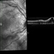 CRVO-associated Macular Edema CRVO-associated Macular Edema