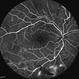 Proliferative Diabetic Retinopathy (PDR) Proliferative Diabetic Retinopathy (PDR)
