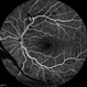 Proliferative Diabetic Retinopathy (PDR) Proliferative Diabetic Retinopathy (PDR)