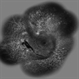 Proliferative Diabetic Retinopathy (PDR) Proliferative Diabetic Retinopathy (PDR)